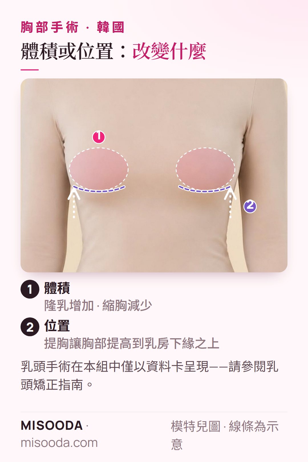 韓國 隆乳、縮胸與提胸在著衣模特兒身上的示意:胸部體積區域,以及提胸將胸部提高到乳房下緣之上