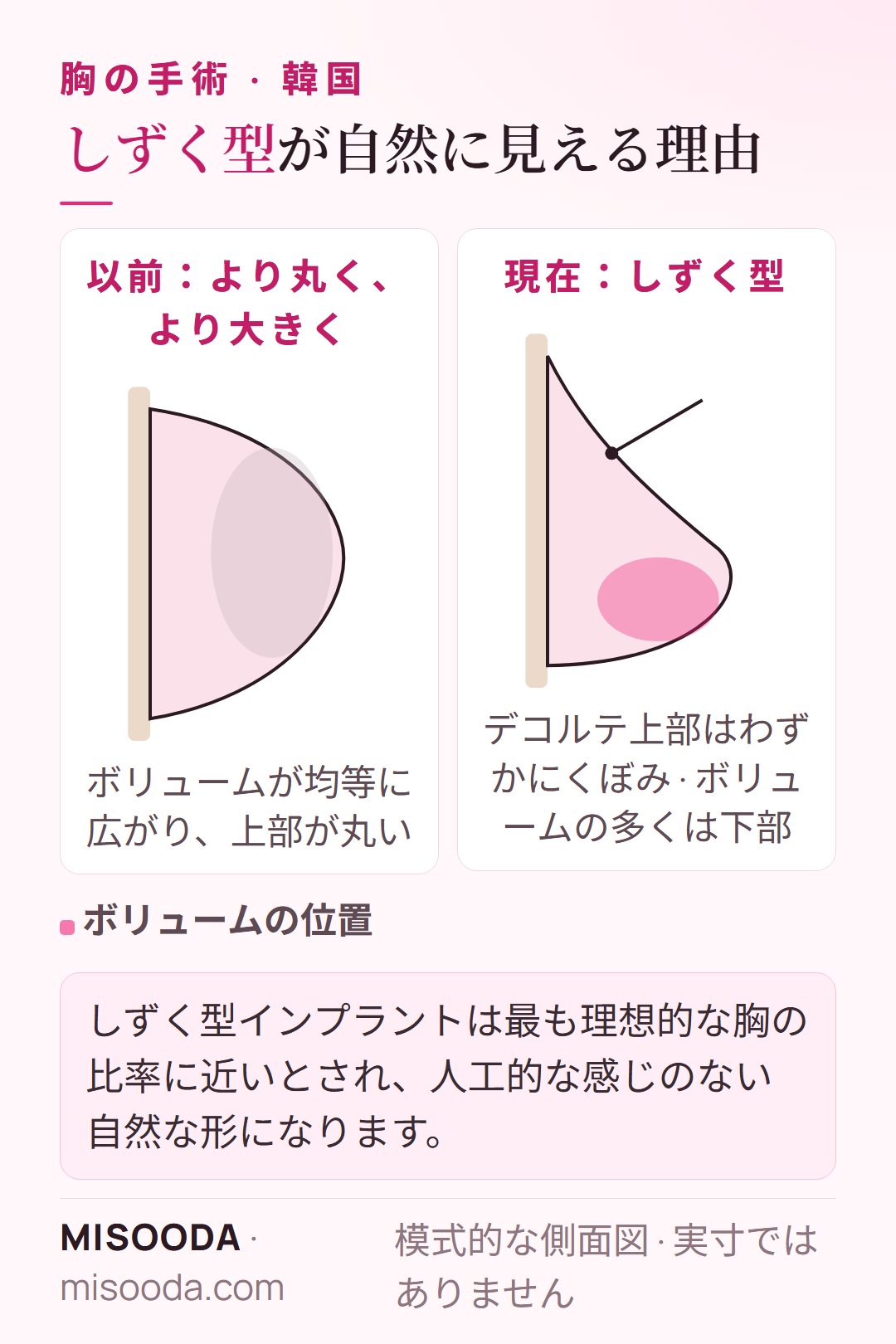 しずく型と丸型の豊胸インプラント:しずく型はボリュームの多くを胸の下部に置き、デコルテ上部をわずかにくぼませて自然な比率に — 韓国 豊胸