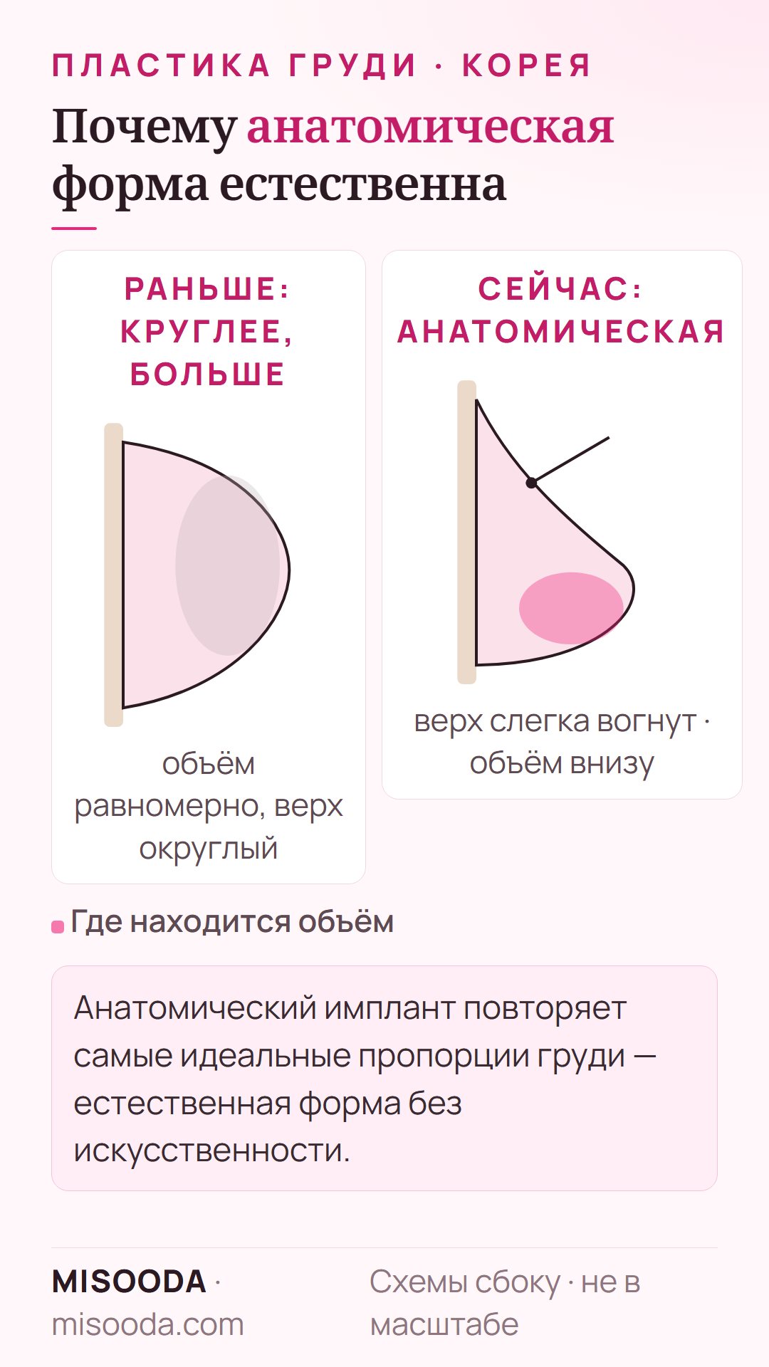 Анатомический имплант груди и круглая форма: анатомический даёт основной объём в нижней части и слегка вогнутый верх для естественных пропорций