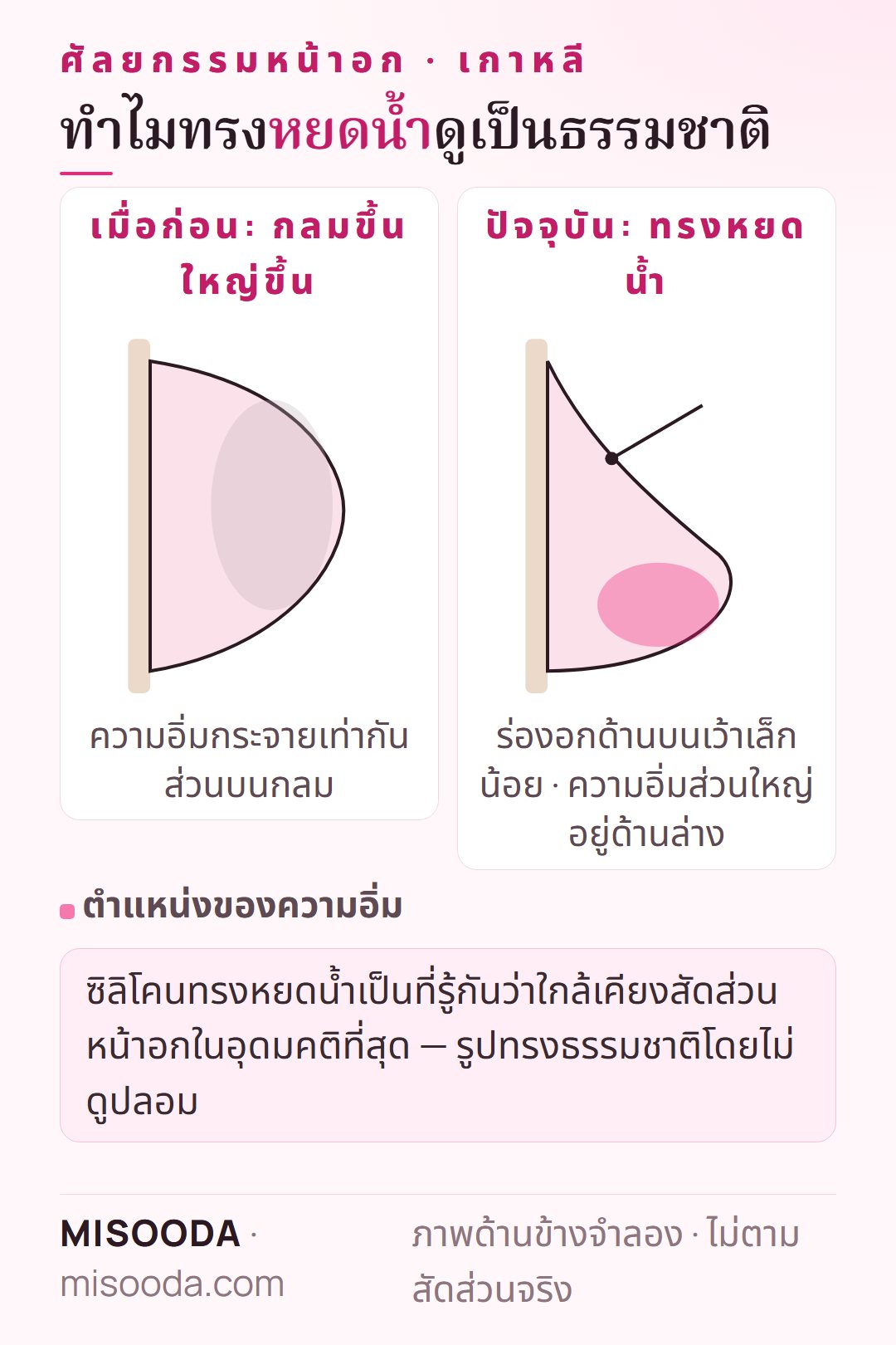 ซิลิโคนหน้าอกทรงหยดน้ำ vs ทรงกลม ศัลยกรรมหน้าอก เกาหลี: ทรงหยดน้ำให้ความอิ่มส่วนใหญ่อยู่ด้านล่าง ร่องอกบนเว้าเล็กน้อยเพื่อสัดส่วนธรรมชาติ