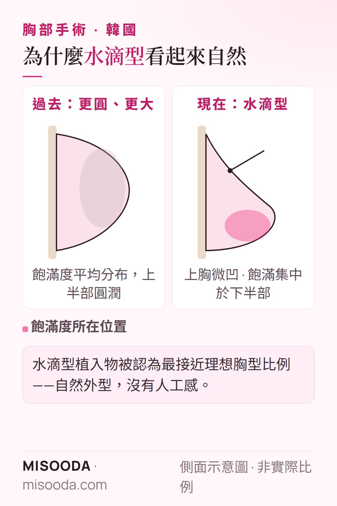 韓國 隆乳 水滴型植入物 vs 圓型:水滴型讓飽滿度集中在胸部下半部,上胸微凹,呈現自然比例