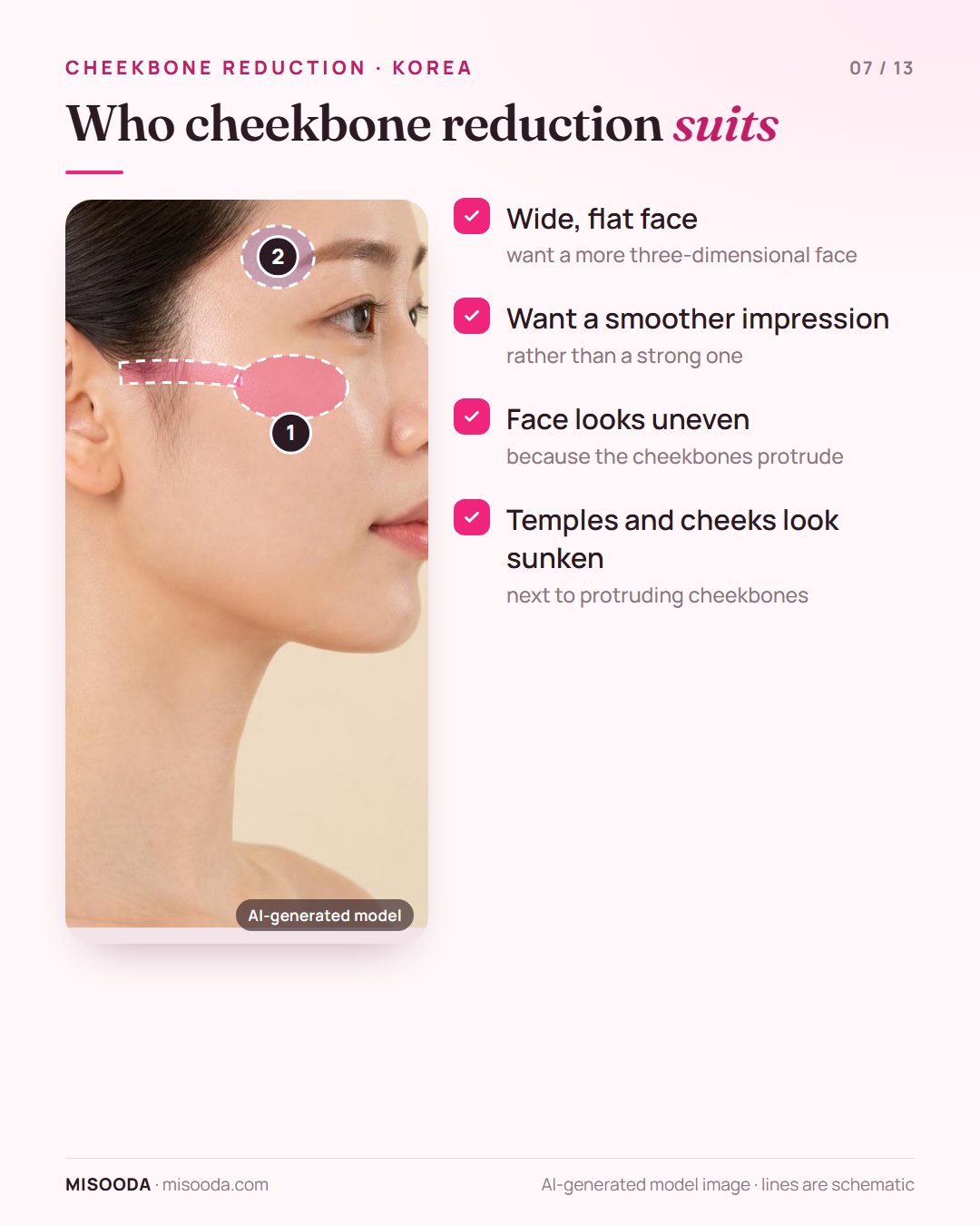 Candidates for cheekbone reduction: wide flat face, wanting a smoother impression, uneven look from protruding cheekbones, sunken temples and cheeks