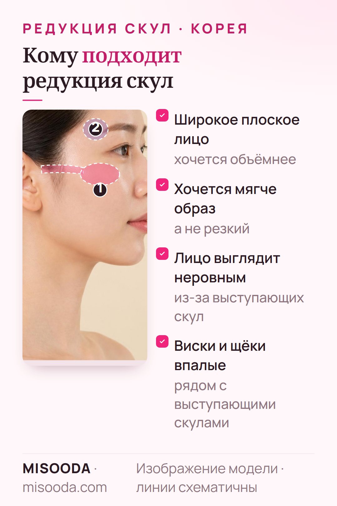 Кому подходит редукция скул: широкое плоское лицо, желание более мягкого облика, неровный вид из-за выступающих скул, впалые виски и щёки