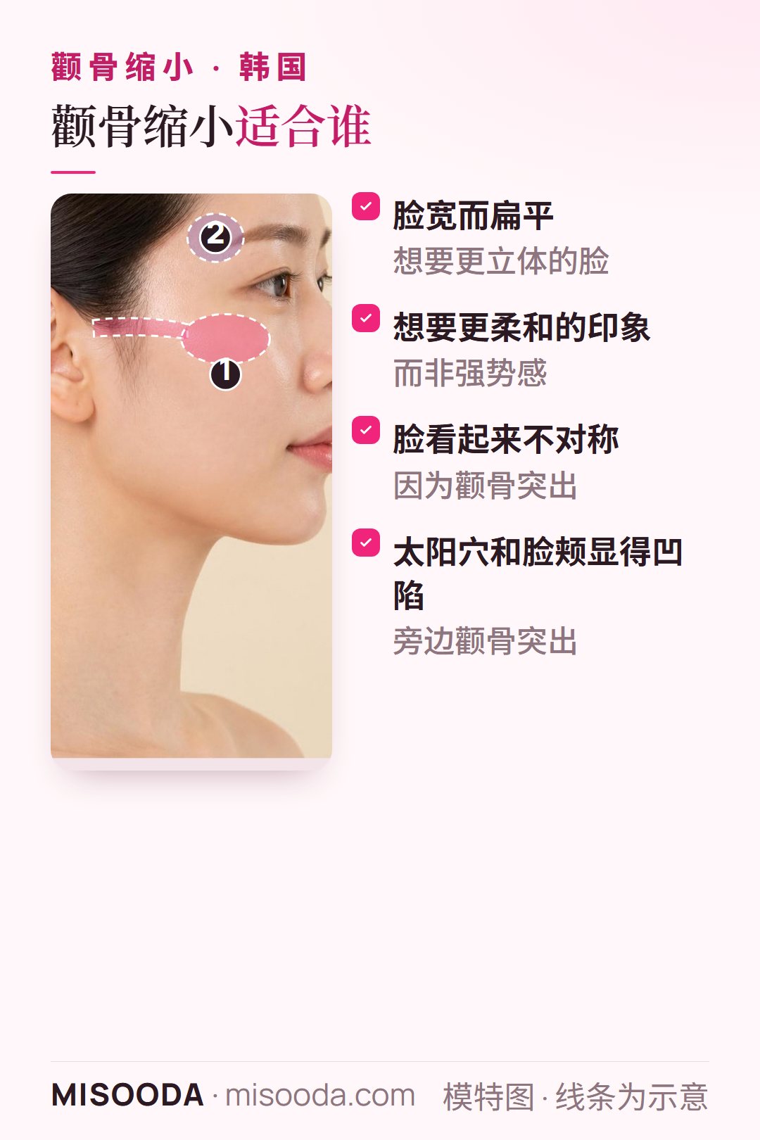 颧骨缩小适合谁:脸宽扁平、想要更柔和的印象、颧骨突出导致不对称、太阳穴和脸颊凹陷的人