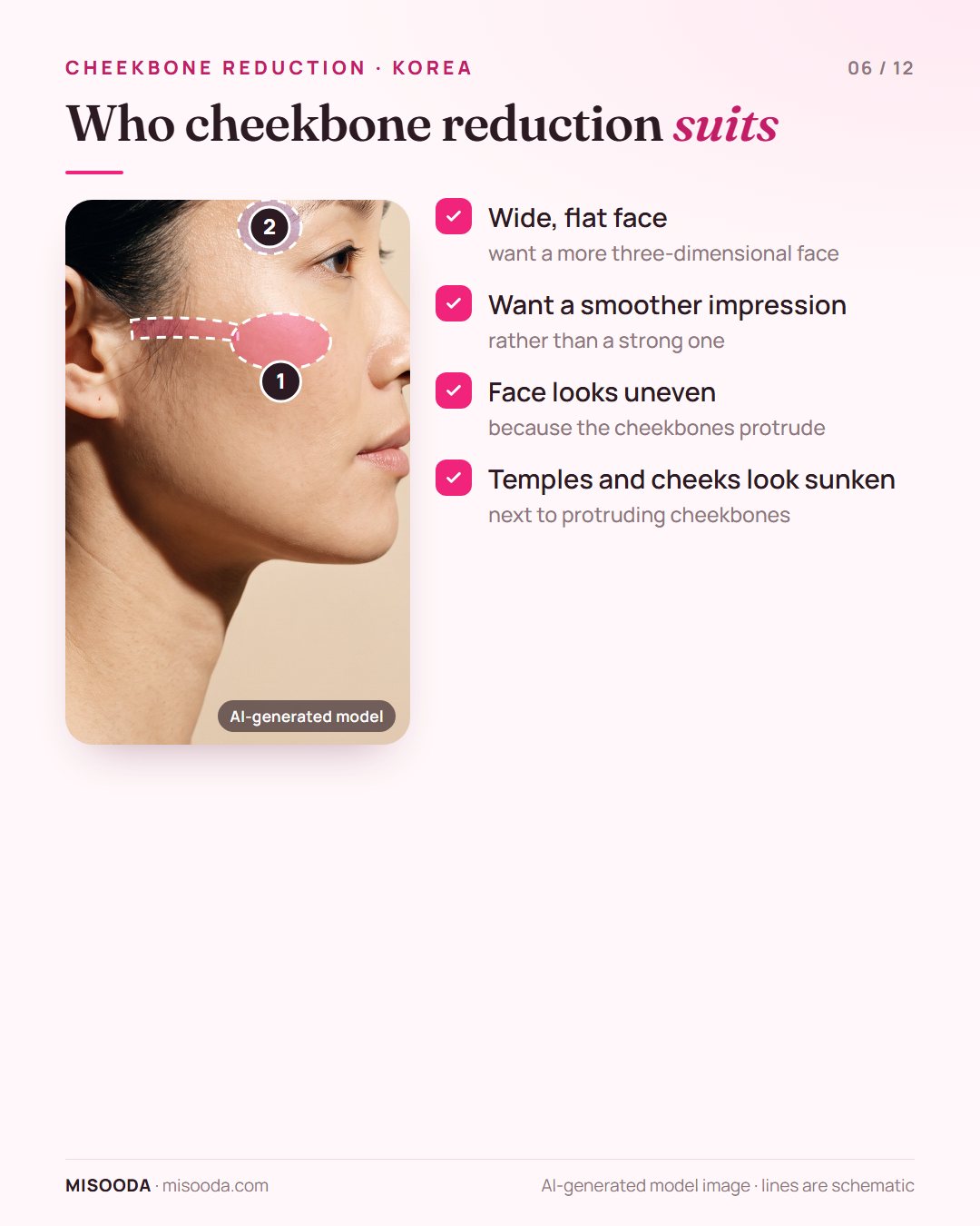 Candidates for cheekbone reduction: wide flat face, wanting a smoother impression, uneven look from protruding cheekbones, sunken temples and cheeks