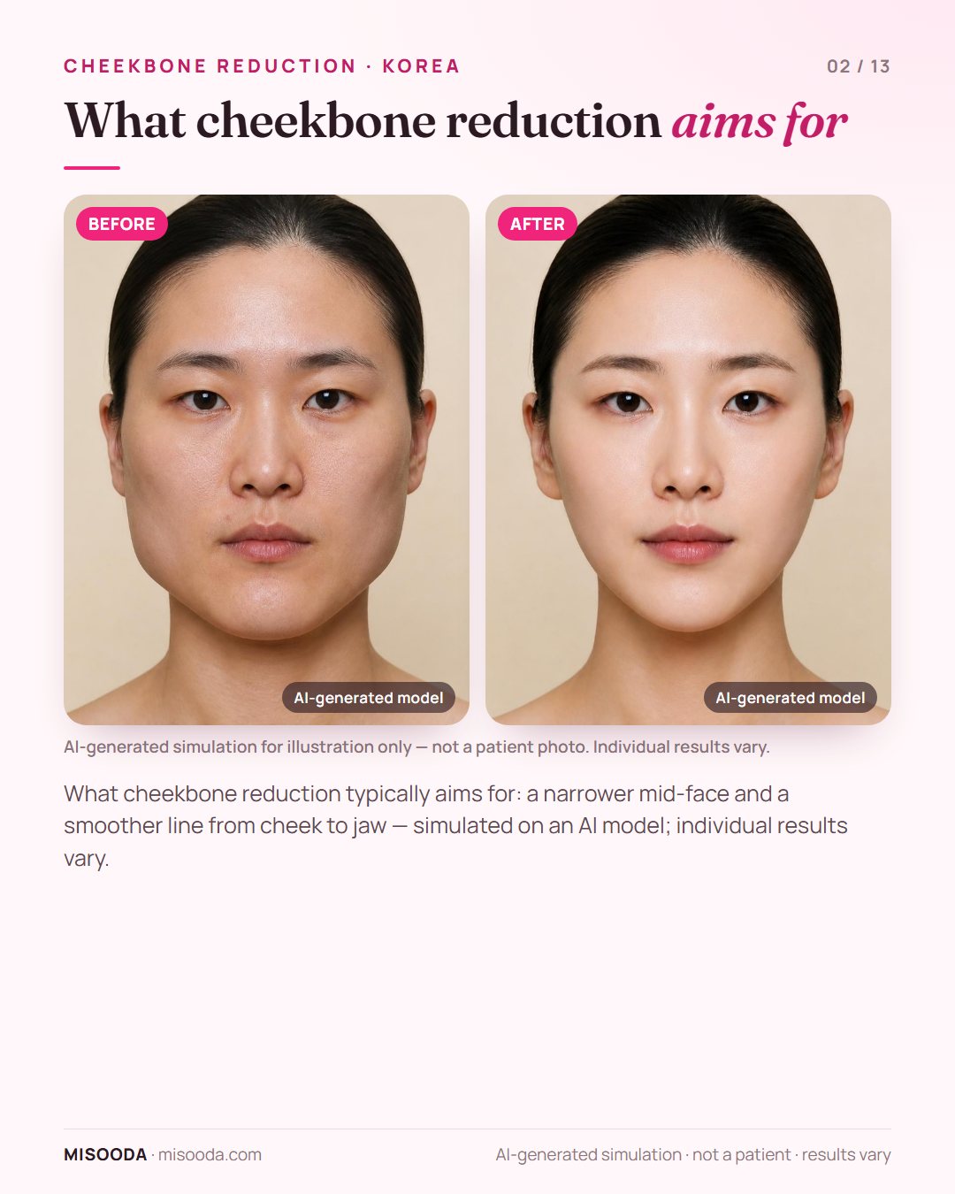 Illustration of the typical goals of cheekbone (zygoma) reduction — a narrower mid-face and a smoother cheek-to-jaw line — simulated on an AI model