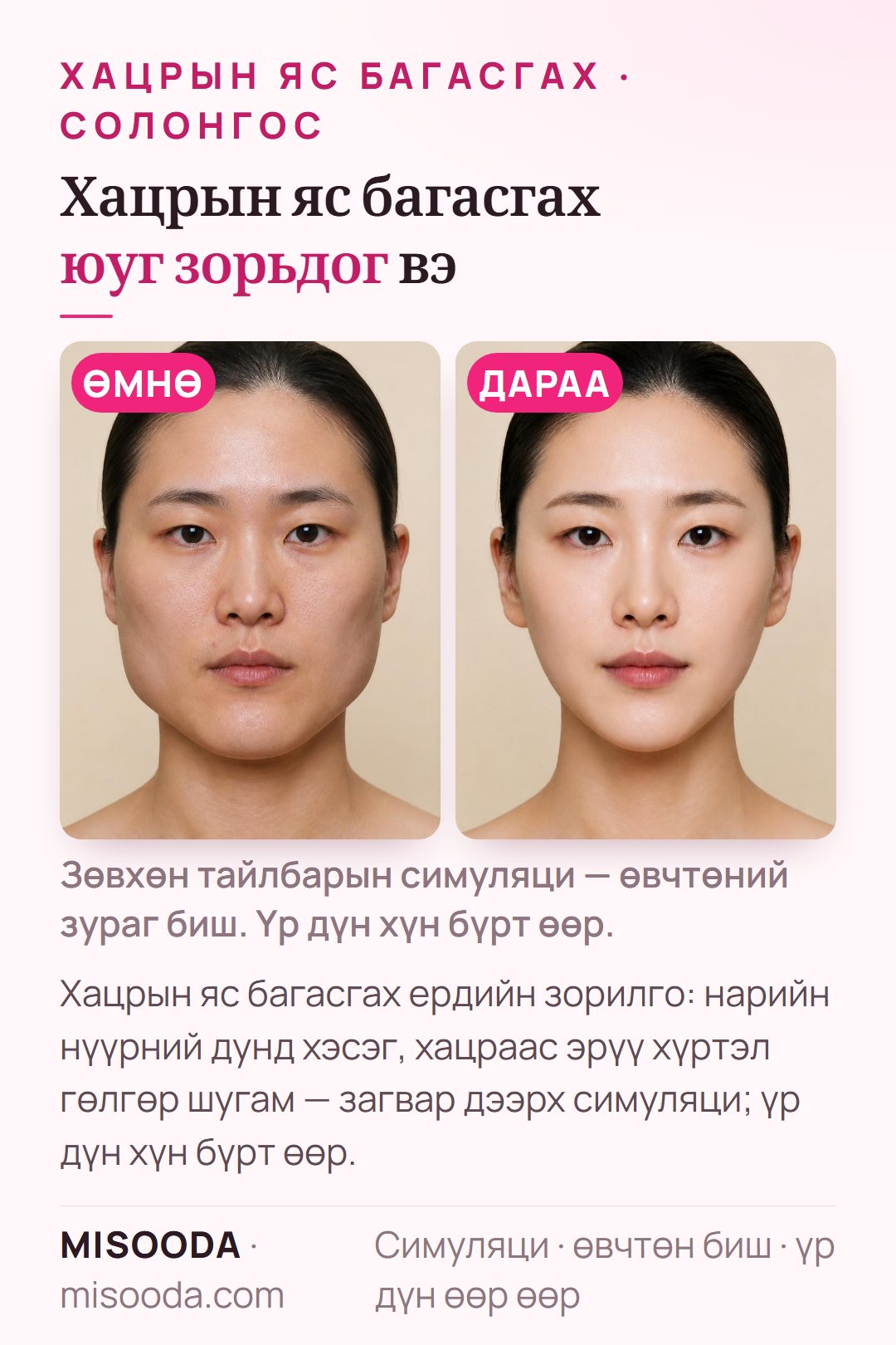 Хацрын яс (зигома) багасгах ердийн зорилгын зураг — нарийн нүүрний дунд хэсэг, хацраас эрүү хүртэл гөлгөр шугам — загвар дээрх симуляци