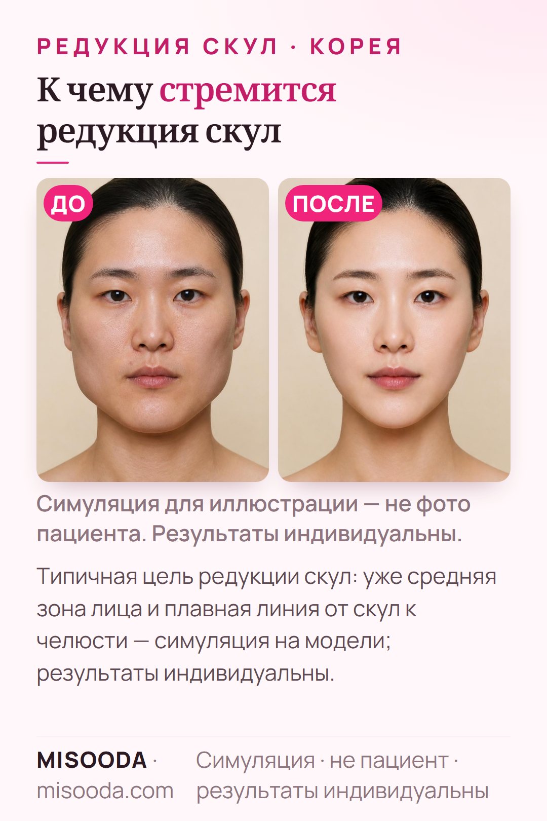 Иллюстрация типичных целей редукции скул (зигомы) — более узкая средняя зона лица и плавная линия от скул к челюсти — смоделировано на модели