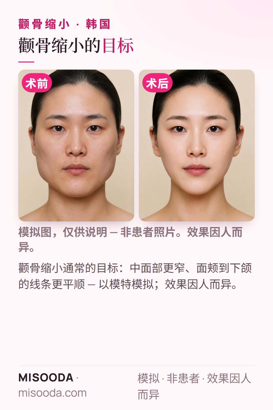韩国颧骨缩小手术常见目标示意图 — 中面部更窄、面颊到下颌的线条更平顺 — 以模特模拟呈现,仅供了解颧骨手术希望达到的方向,效果因人而异