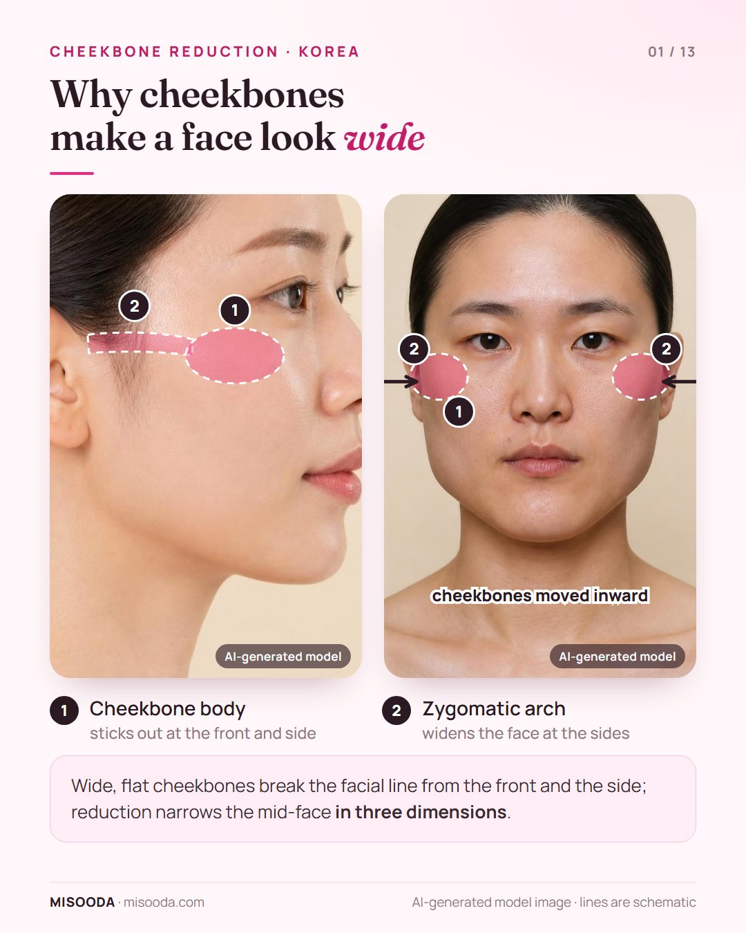 Cheekbone (zygoma) reduction in Korea: protruding cheekbone body and zygomatic arch shown on a side profile and a front-view schematic of a narrower mid-face
