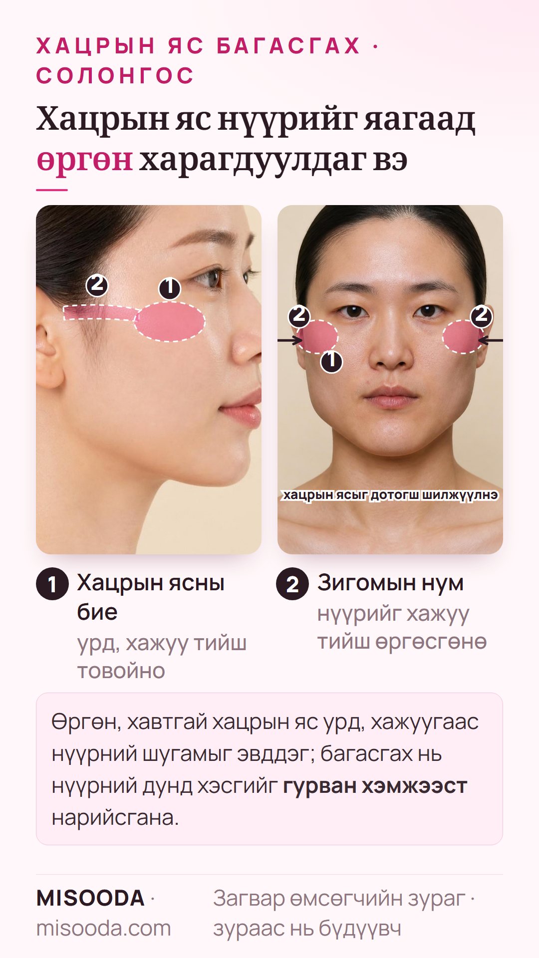 Солонгост хацрын яс (зигома) багасгах: товойсон хацрын ясны бие, зигомын нумыг хажуу профиль ба нарийссан нүүрний дунд хэсгийн урд талын бүдүүвчээр