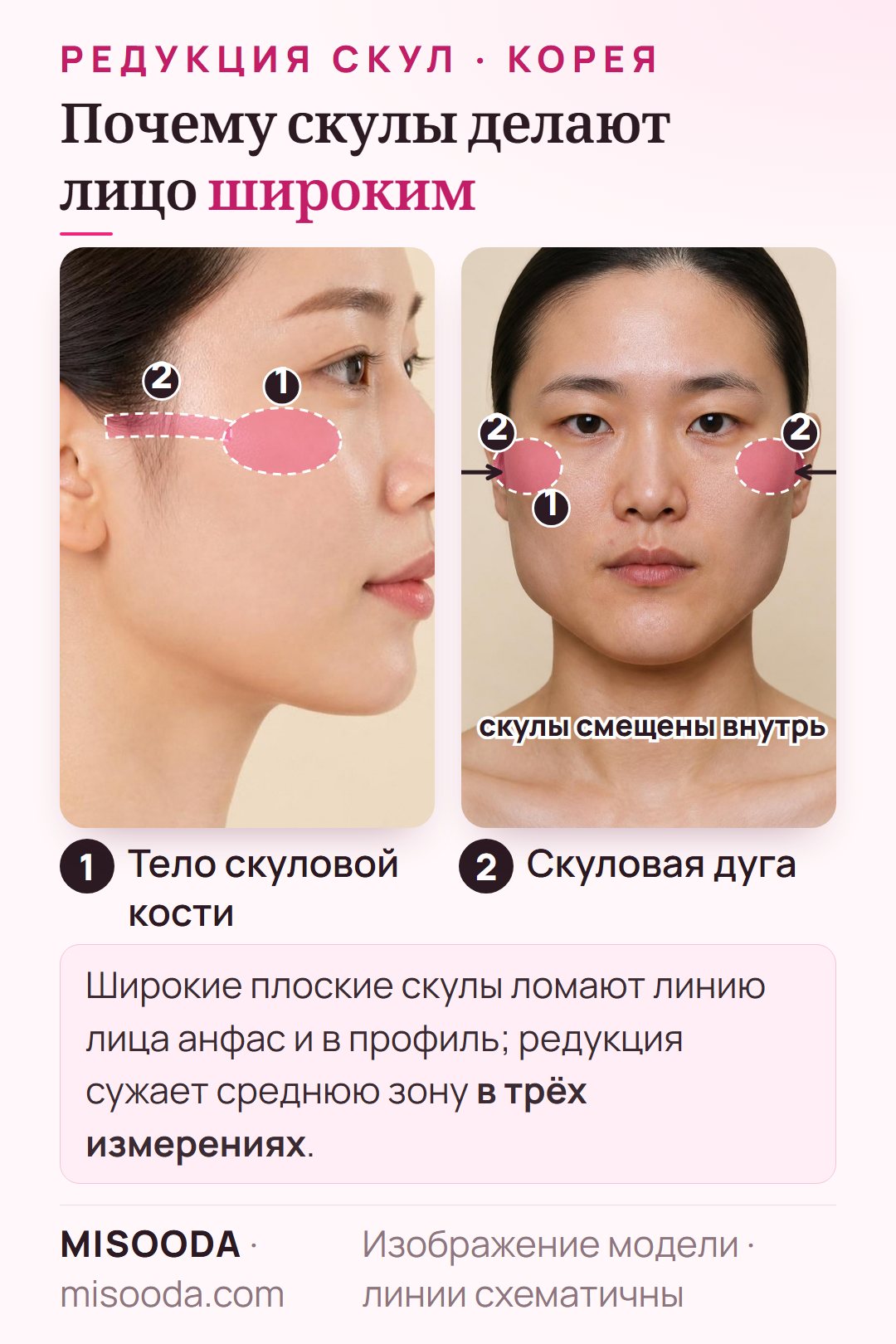 Редукция скул (зигомы) в Корее: выступающее тело скуловой кости и скуловая дуга в профиль и схема более узкой средней зоны лица анфас