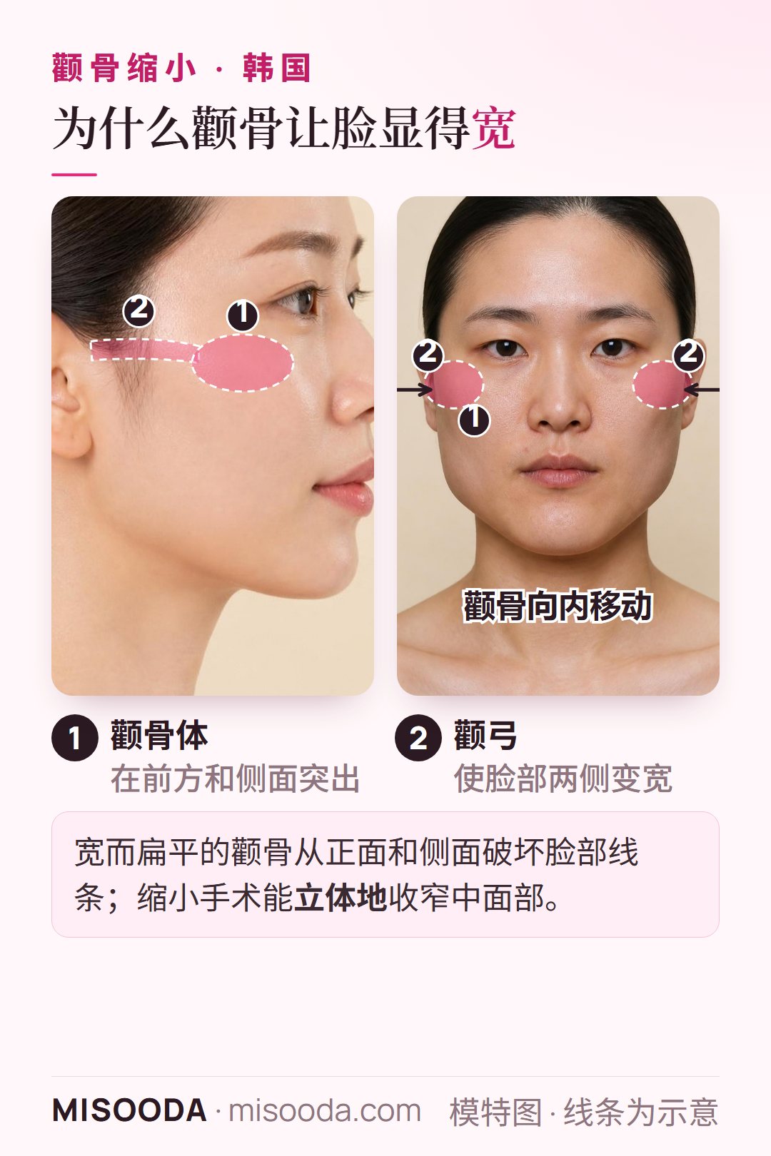 韩国颧骨缩小手术(颧骨内推):在侧脸轮廓上标出向前和向侧面突出的颧骨体与颧弓,并以正面示意图展示缩小后中面部变窄、脸型更立体柔和