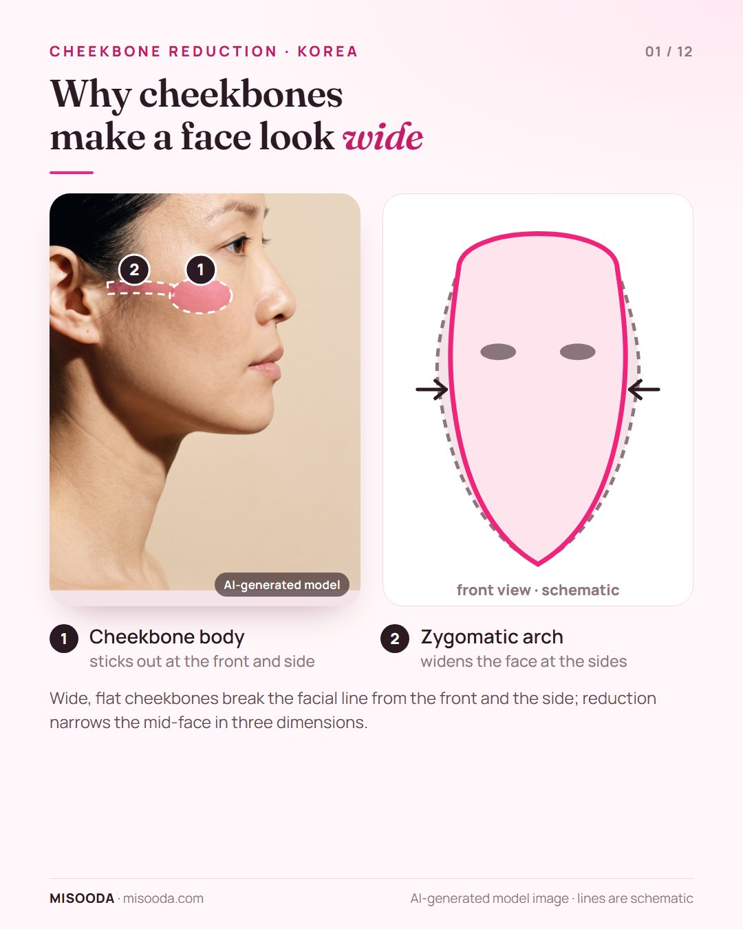 Cheekbone (zygoma) reduction in Korea: protruding cheekbone body and zygomatic arch shown on a side profile and a front-view schematic of a narrower mid-face