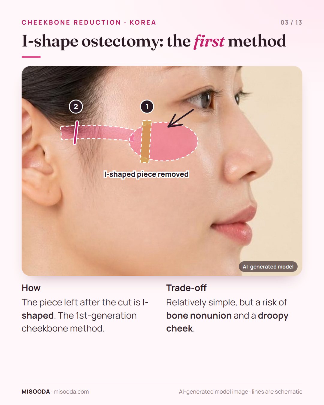 I-shape ostectomy for cheekbone reduction: an I-shaped bone piece removed from the cheekbone body plus an arch cut; simple but with nonunion and droop risk