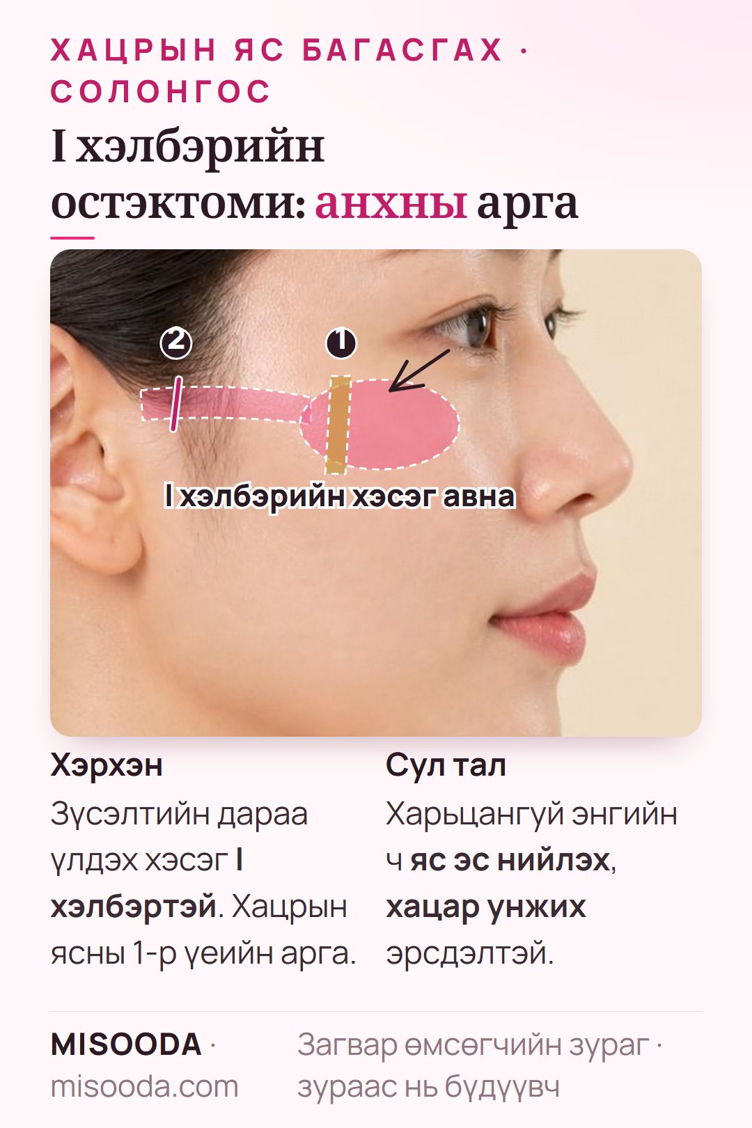 Хацрын яс багасгах I хэлбэрийн остэктоми: хацрын ясны биеэс I хэлбэрийн ясыг авч, нумыг зүснэ; энгийн ч яс эс нийлэх, унжих эрсдэлтэй