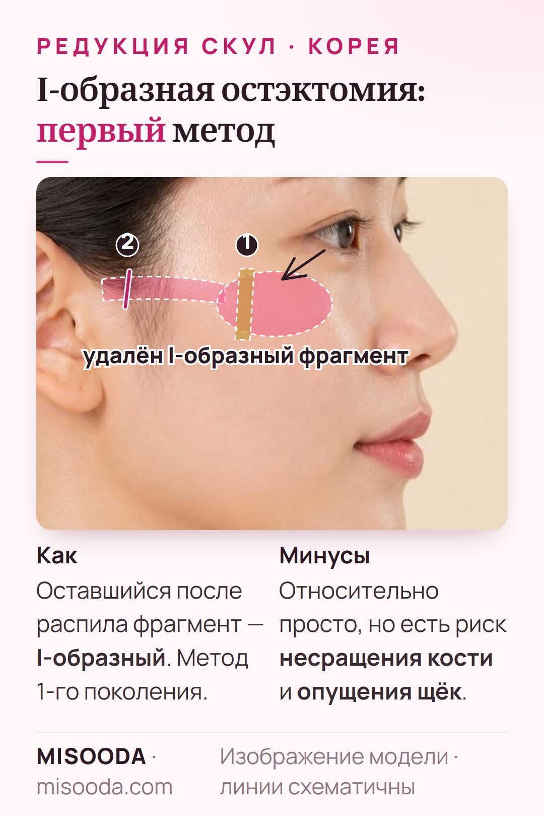 I-образная остэктомия при редукции скул: удаление I-образного фрагмента из тела скуловой кости и распил дуги; метод простой, но есть риск несращения кости и опущения тканей