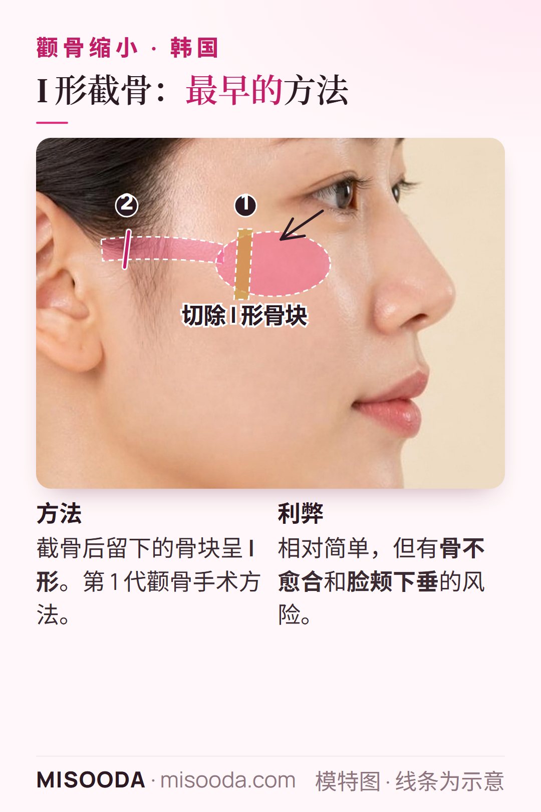 颧骨缩小 I 形截骨:从颧骨体切除 I 形骨块并切断颧弓;方法简单,但有骨不愈合和下垂风险