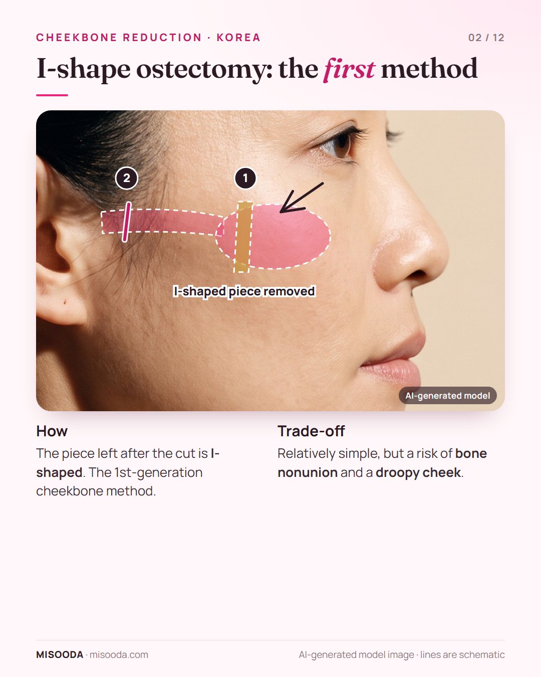I-shape ostectomy for cheekbone reduction: an I-shaped bone piece removed from the cheekbone body plus an arch cut; simple but with nonunion and droop risk
