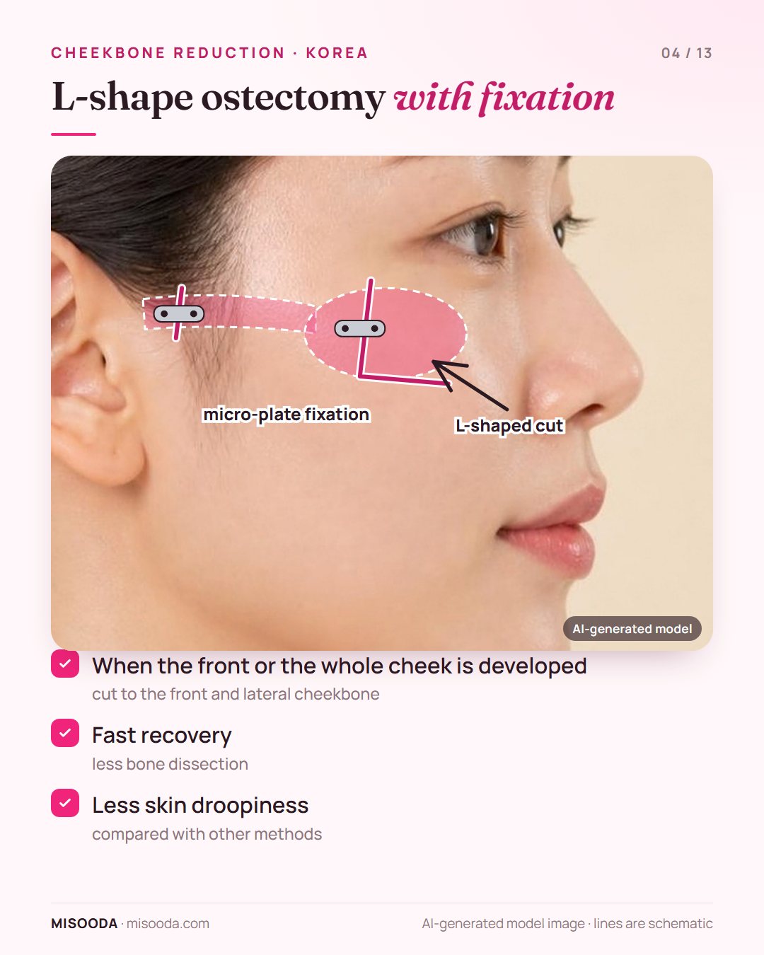 L-shape ostectomy with fixation for zygoma reduction: L-shaped cut on the front and lateral cheekbone fixed with micro-plates; fast recovery, less droopiness