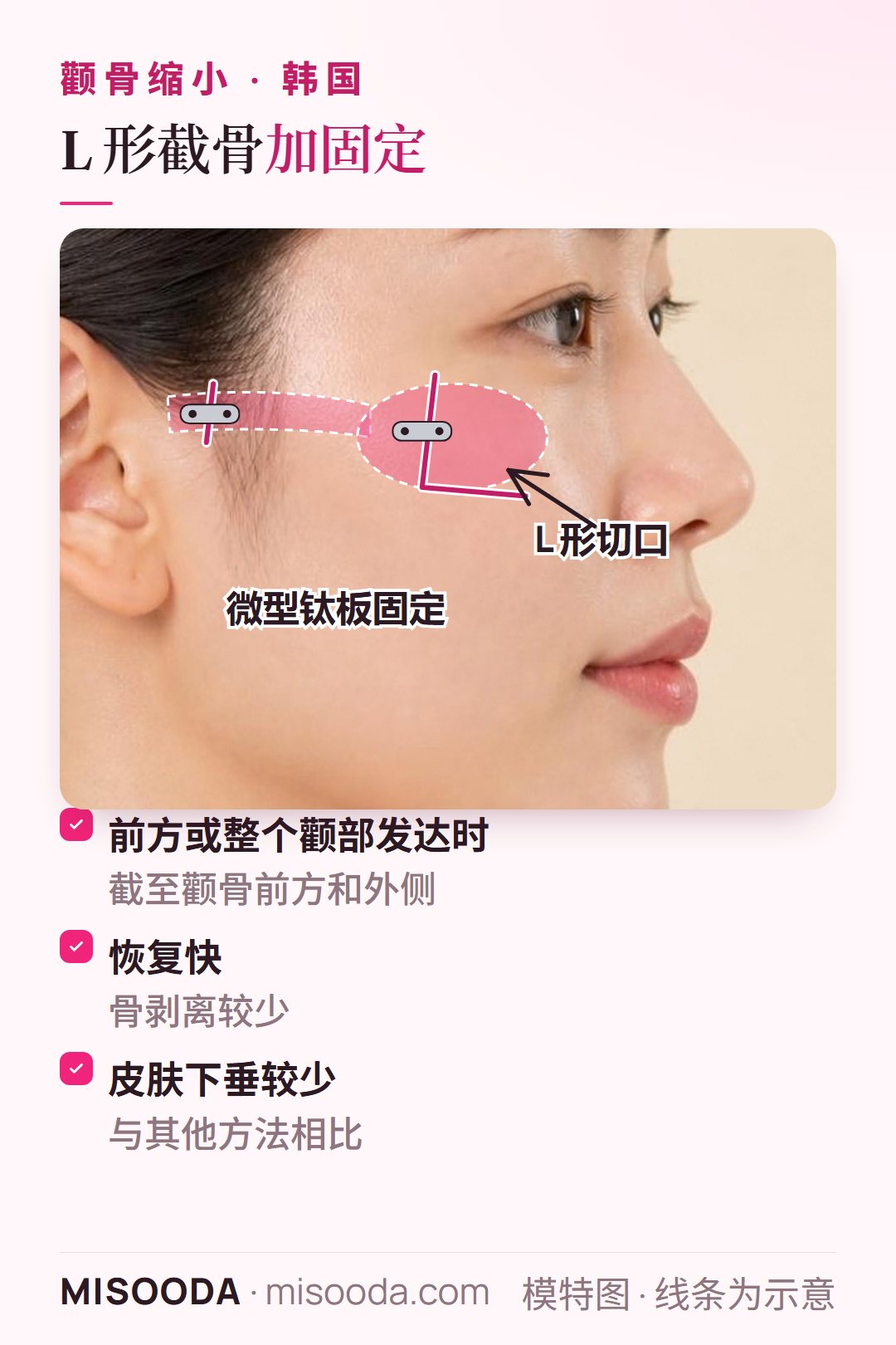 韩国颧骨缩小 L 形截骨加固定:在颧骨前方和外侧做 L 形切口并用微型钛板固定;恢复快、下垂少