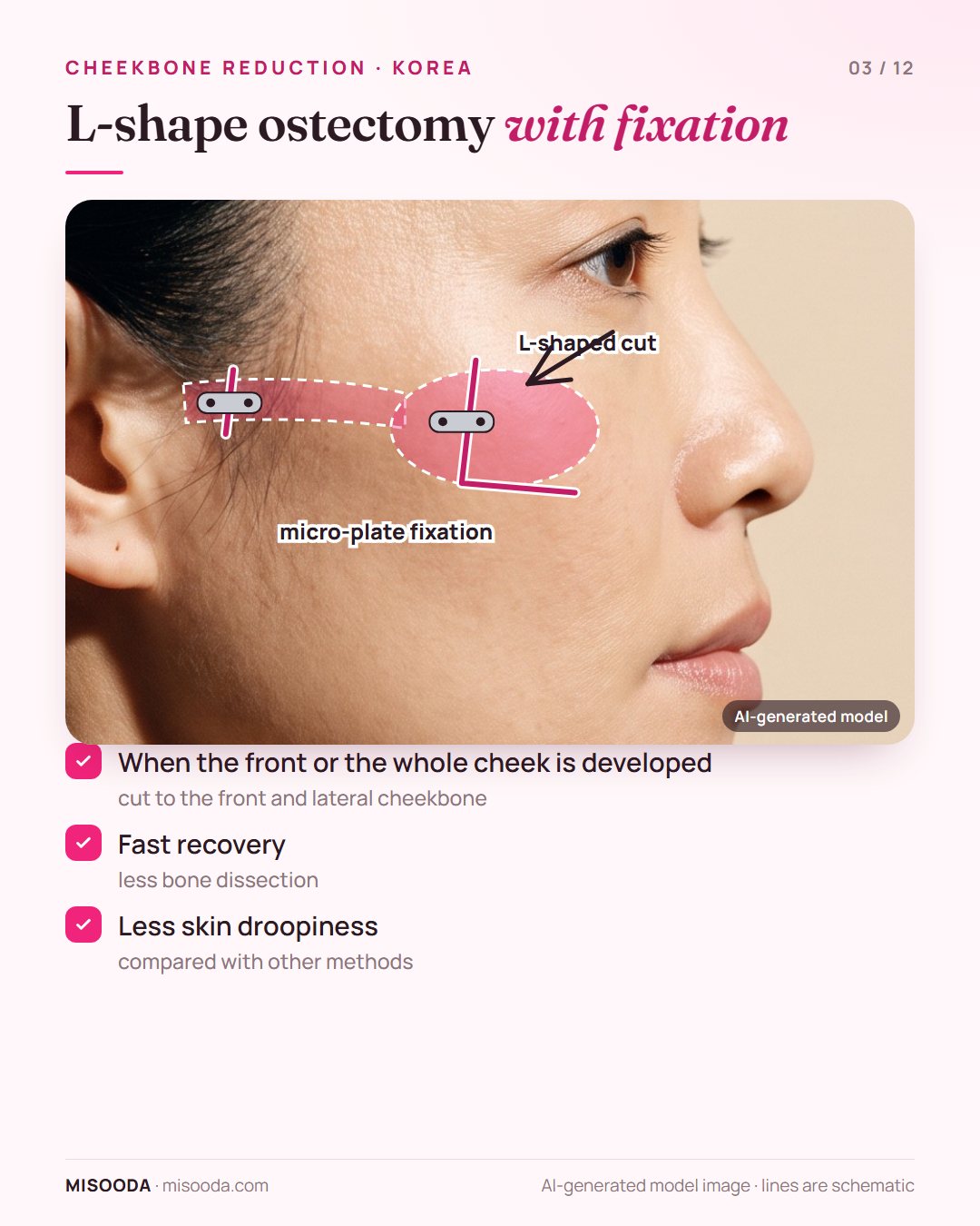 L-shape ostectomy with fixation for zygoma reduction: L-shaped cut on the front and lateral cheekbone fixed with micro-plates; fast recovery, less droopiness