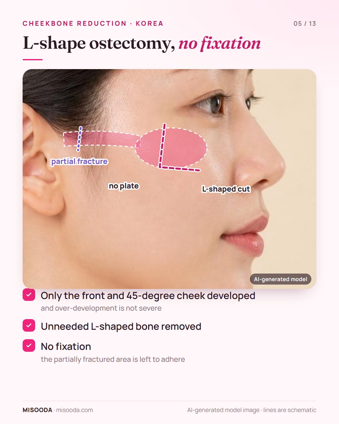 Non-fix L-shape zygoma reduction: L-shaped bone removed and the partially fractured arch left to adhere without plates, for front and 45-degree cheeks