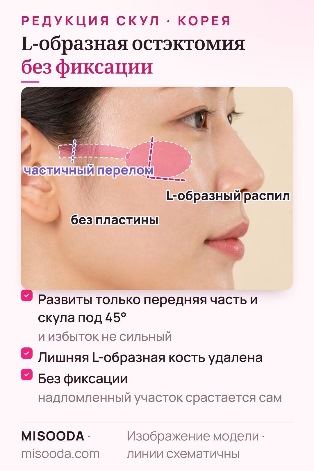 L-образная редукция скул без фиксации: L-образный фрагмент кости удаляется, а частично надломленная дуга срастается без пластин; для передней части скул и скул под углом 45 градусов