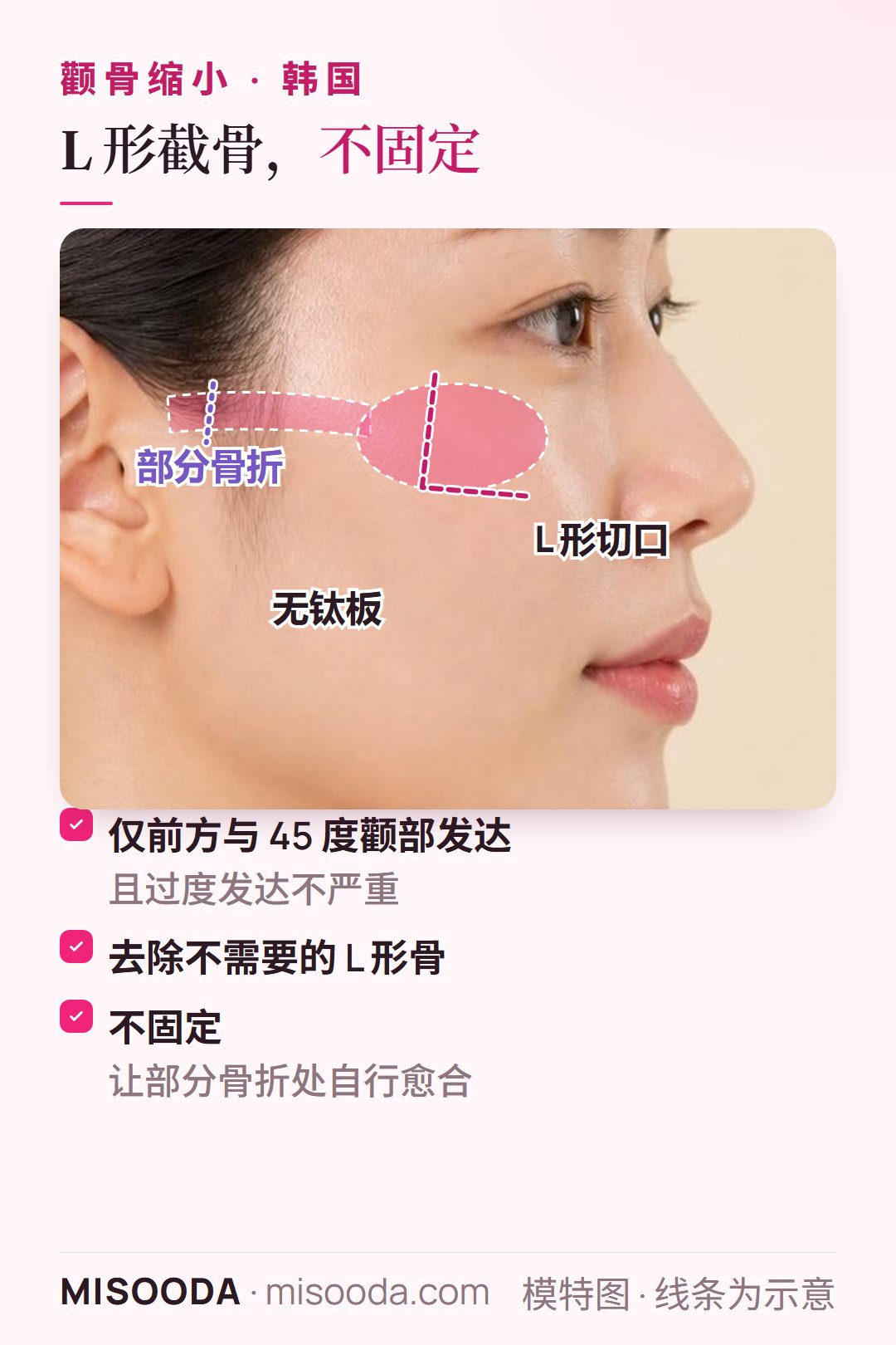 韩国颧骨缩小 L 形不固定:去除 L 形骨,部分骨折的颧弓不用钛板自行愈合,适合前方与 45 度颧部