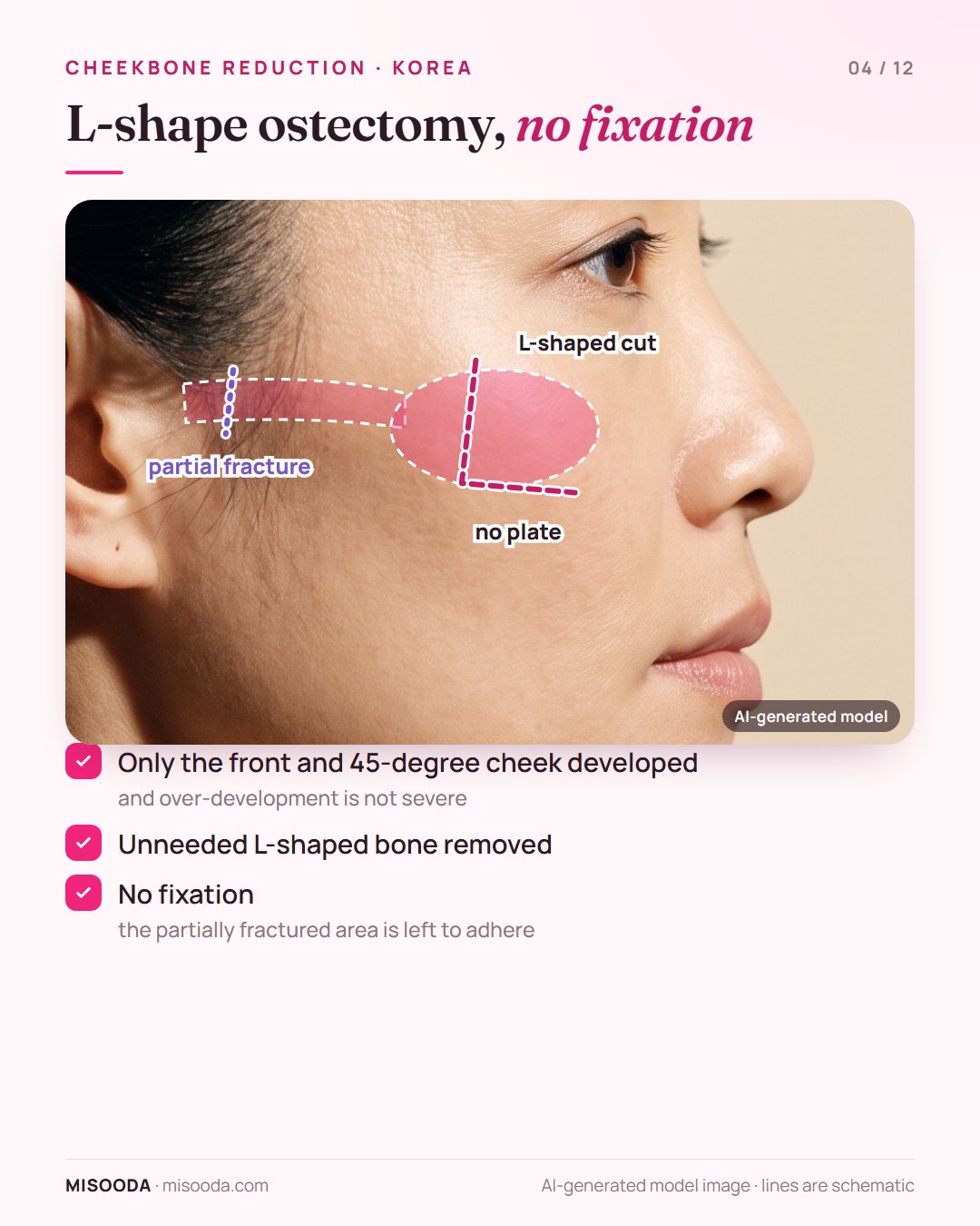 Non-fix L-shape zygoma reduction: L-shaped bone removed and the partially fractured arch left to adhere without plates, for front and 45-degree cheeks