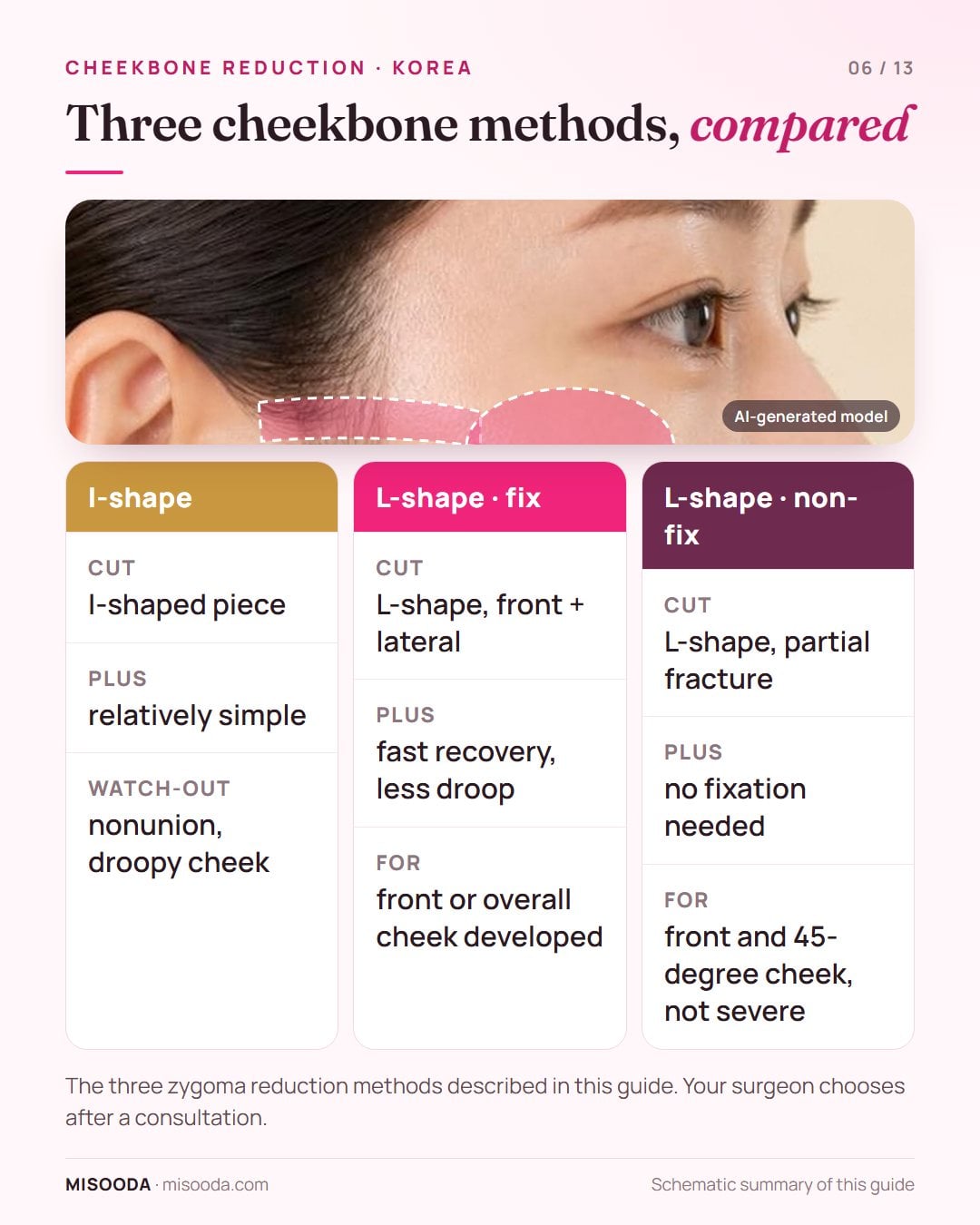 Cheekbone reduction methods compared: I-shape ostectomy, L-shape ostectomy with fixation and L-shape non-fix, with who each suits and their trade-offs
