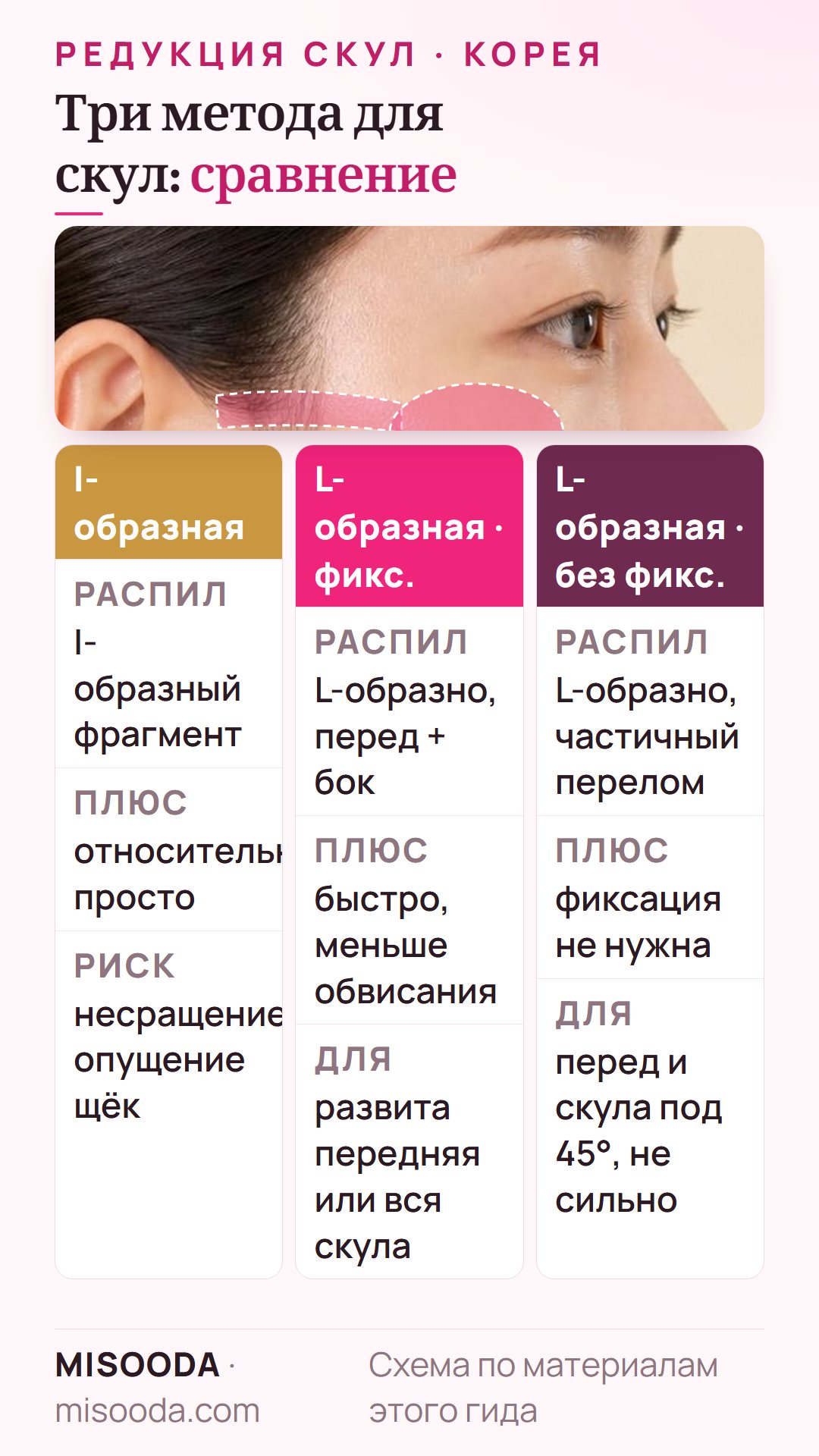 Сравнение методов редукции скул: I-образная остэктомия, L-образная остэктомия с фиксацией и L-образная без фиксации — кому подходит каждый метод, их плюсы и минусы
