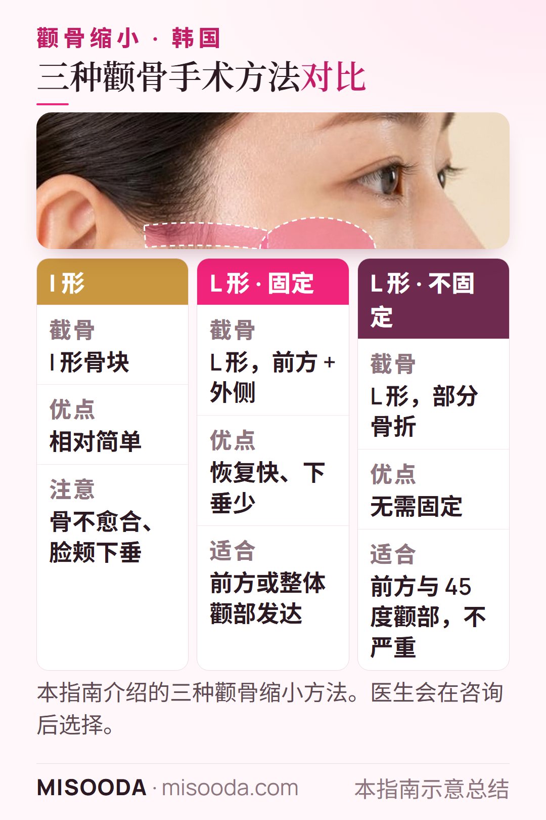 韩国颧骨缩小方法对比:I 形截骨、L 形截骨加固定与 L 形不固定,各自适合人群与利弊一目了然