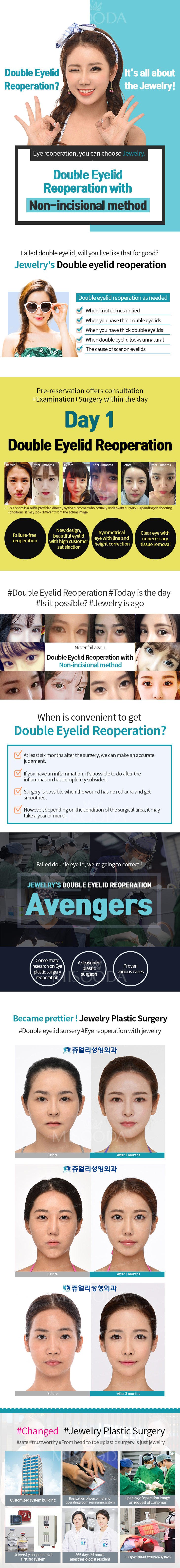 Double eyelid reoperation with Non-incisional method (Contact MISOODA for price)