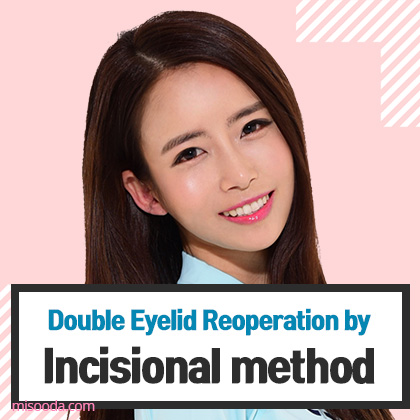 Double Eyelid Reopreation by incisional method (Contact MISOODA for price)