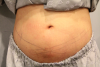 Coolsculpting (zeltiq) procedure at wannabe clinic