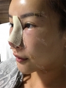 The day of operation : 
I felt like I was in a dream after the anesthesia. After the surgery, a nurse woke me up, there was nothing hurt. But, only thing uncomfortable was that I had difficulty with breathing with nose due to the cotton that blocked breathing. So, I had to breathe with my mouth, so that my mouth became dry easily.