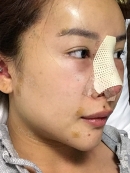 The day of operation : 
I felt like I was in a dream after the anesthesia. After the surgery, a nurse woke me up, there was nothing hurt. But, only thing uncomfortable was that I had difficulty with breathing with nose due to the cotton that blocked breathing. So, I had to breathe with my mouth, so that my mouth became dry easily.