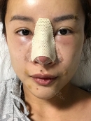 The day of operation : 
I felt like I was in a dream after the anesthesia. After the surgery, a nurse woke me up, there was nothing hurt. But, only thing uncomfortable was that I had difficulty with breathing with nose due to the cotton that blocked breathing. So, I had to breathe with my mouth, so that my mouth became dry easily.