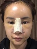 Day 3 : 
I had to take a walk every day and apply an icepack on my nose to reduce swelling. Unfortunately, I couldn’t help with bruise and swelling. During the treatment, a nurse told me that I’d got more swelling due to fat graft. I wouldn’t have this much swelling if I only had the nose surgery.