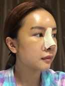 Day 7 : 
Finally, I’d been waited for a long time to remove threads. I couldn’t wait to see the shape of my nose since I was worried about my hump nose. It looks more natural than I expected, so I’m very satisfied with the result. I love the side-line of my face. After the swelling was getting reduced, it would look prettier. I was so excited to see my face!