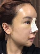 Day 3 : 
I had to take a walk every day and apply an icepack on my nose to reduce swelling. Unfortunately, I couldn’t help with bruise and swelling. During the treatment, a nurse told me that I’d got more swelling due to fat graft. I wouldn’t have this much swelling if I only had the nose surgery.