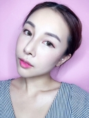 After 6 months : 
Do you see my side-line? Isn’t it incredible? I really do love it. Choosing Cinderella was the best decision I’ve ever made. I admire the efforts of Dr. Chung and staffs; they were very nice to me. I asked so many questions every day because I was worried too much. Thanks a lot for all very kind and detailed information from them. Now, I’m very satisfied and blissful.