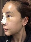 Day 3 : 
I had to take a walk every day and apply an icepack on my nose to reduce swelling. Unfortunately, I couldn’t help with bruise and swelling. During the treatment, a nurse told me that I’d got more swelling due to fat graft. I wouldn’t have this much swelling if I only had the nose surgery.