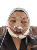 Sorry in advance, these photos are scary!!!! I got really swollen and they actually had to restitch my epi while I was under GA because the rhino swelling could cause the epi to become undone. I think because I got so many surgeries I got extra bad swelling. When I got home I drank some oat milk and chatted with roommates, then iced my face for the rest of the night. Girin bought me some porridge from a restaurant but it was too thick for me to eat (so sad).