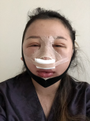 Sorry in advance, these photos are scary!!!! I got really swollen and they actually had to restitch my epi while I was under GA because the rhino swelling could cause the epi to become undone. I think because I got so many surgeries I got extra bad swelling. When I got home I drank some oat milk and chatted with roommates, then iced my face for the rest of the night. Girin bought me some porridge from a restaurant but it was too thick for me to eat (so sad).