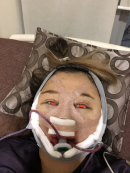 Sorry in advance, these photos are scary!!!! I got really swollen and they actually had to restitch my epi while I was under GA because the rhino swelling could cause the epi to become undone. I think because I got so many surgeries I got extra bad swelling. When I got home I drank some oat milk and chatted with roommates, then iced my face for the rest of the night. Girin bought me some porridge from a restaurant but it was too thick for me to eat (so sad).
