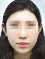 Rhinoplasty