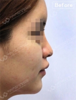 Rhinoplasty