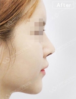 Rhinoplasty